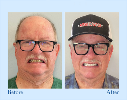 🔥Ends Tonight: Get 60% OFF Before It’s Gone!🎁 BBOJI™ Fluoride-Free Hydroxyapatite Toothpaste – Gentle Whitening & Enamel Strength for Sensitive Teeth