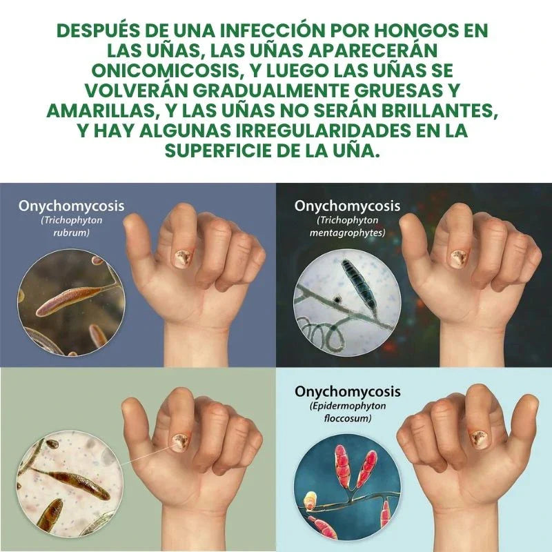 🔥Hot Sale 50% Off🎁7 DAYS NAIL FUNGUS TREATMENT - Protege y elimina el hongo de tus Uñas