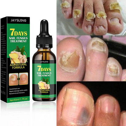 🔥Hot Sale 50% Off🎁7 DAYS NAIL FUNGUS TREATMENT - Protege y elimina el hongo de tus Uñas